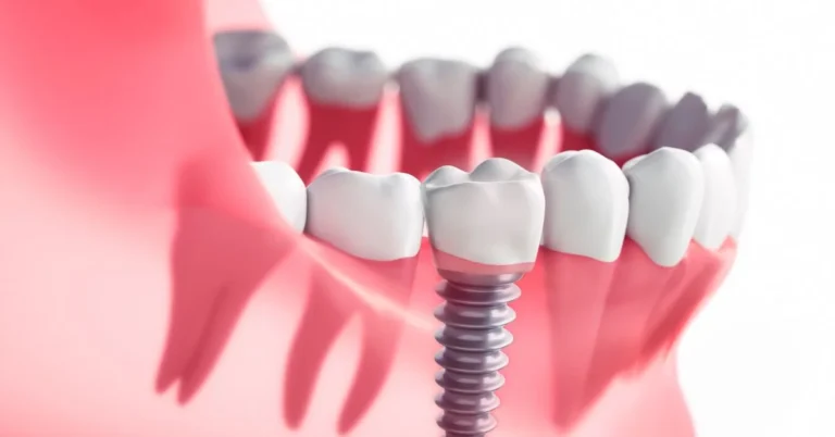 Dental Implants