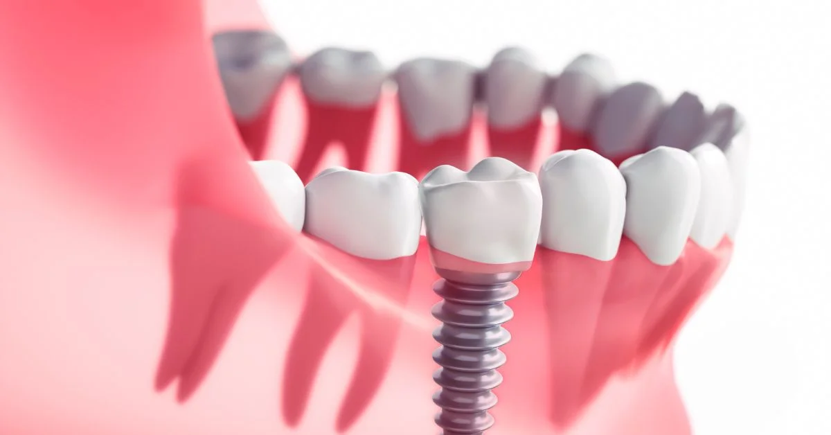 Dental Implants