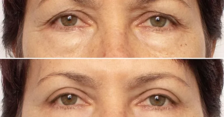 Blepharoplasty