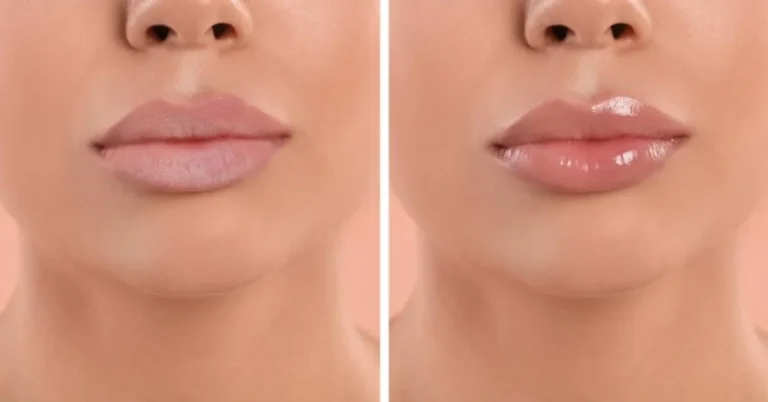 LIP FILLER