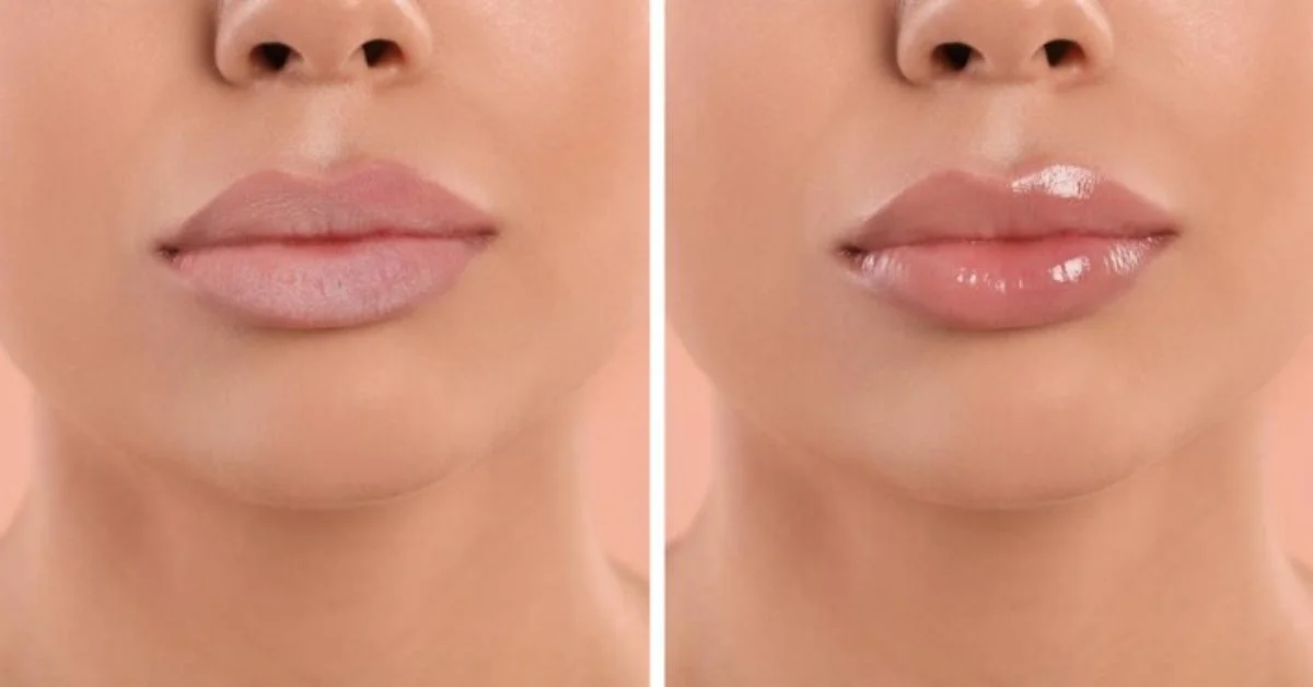 LIP FILLER