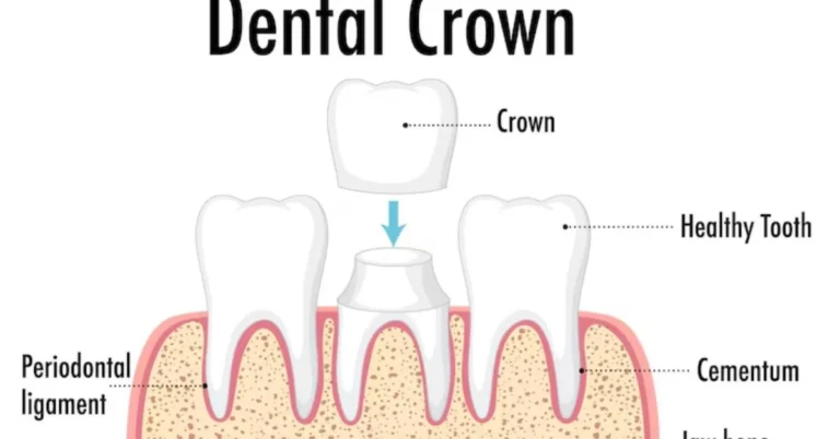 Metal Crown Tooth