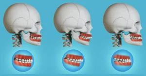 Jaw Surgery