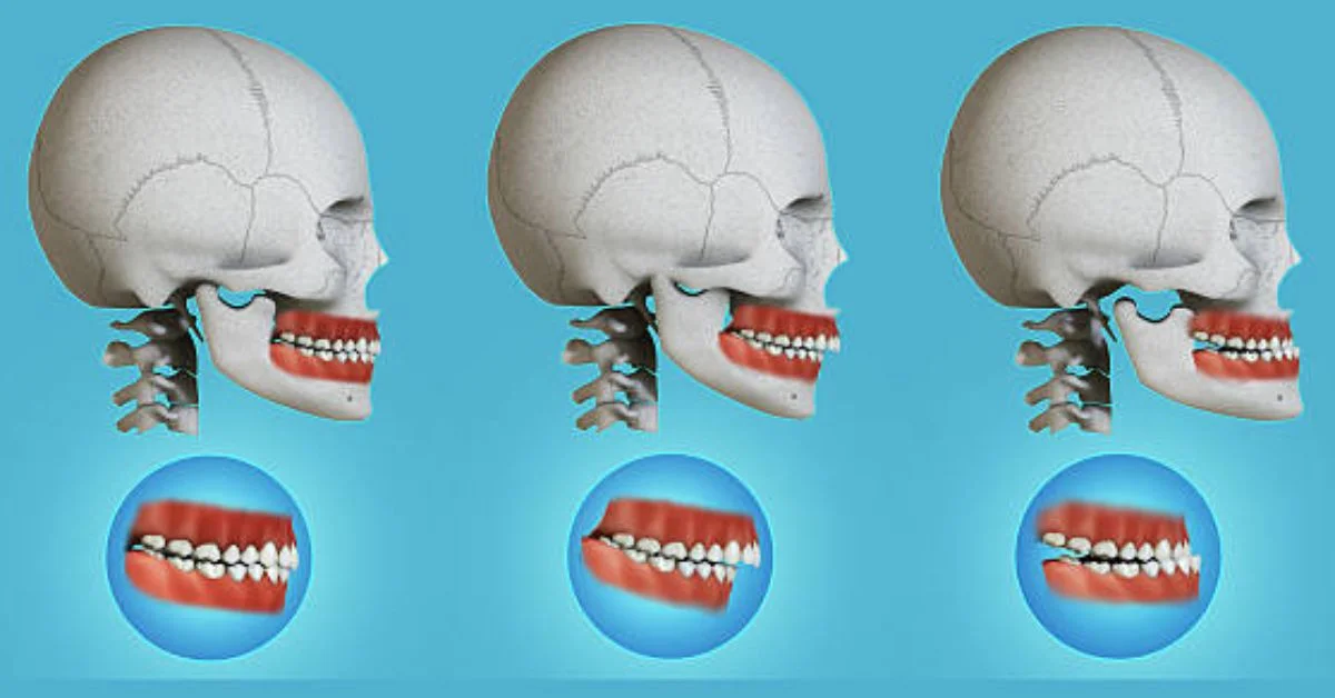 Jaw Surgery