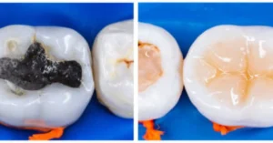 Preventive Resin Restoration