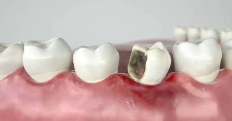 Tooth Filling