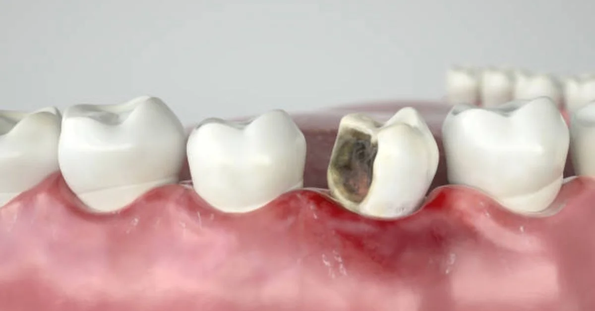 Tooth Filling