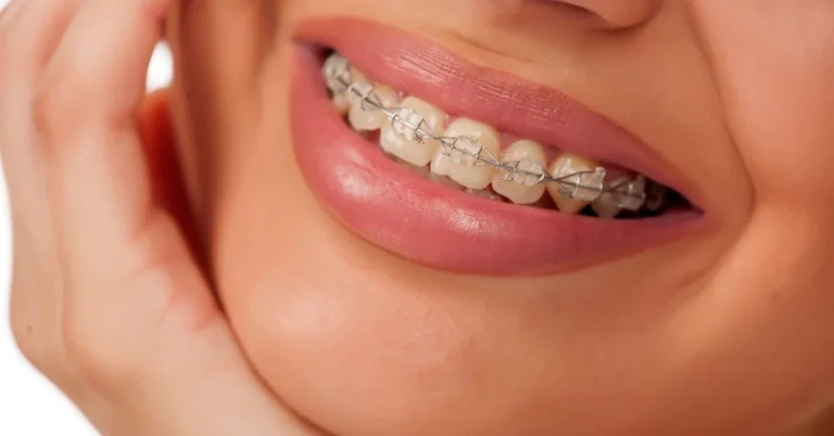 Braces Before and After